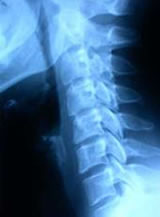 Hernia de Disco Cervical