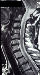 Hernia de Disco Cervical