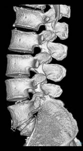 Hernia de Disco Cervical